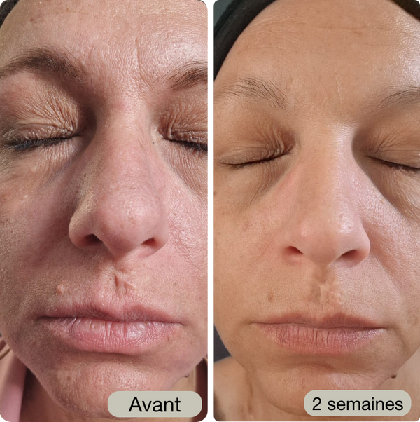Avant / Après de Laurène P.